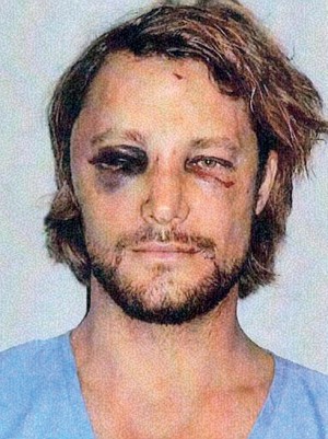 Gabriel Aubry Shows His Badly Bruised Face After Fight With Olivier Martinez